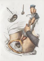 Planche 58 - Opérations de la lithotritie vésicale - Traité complet de l'anatomie de l'homme, par le [...]