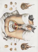 Planche 59 - Opérations de la lithotritie vésicale - Traité complet de l'anatomie de l'homme, par le [...]