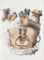 Planche 60 - Opérations de la lithotritie vésicale - Traité complet de l'anatomie de l'homme, par le [...]