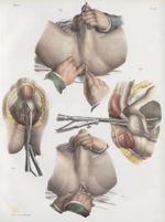 Planche 62 - Opérations de la lithotomie. - Taille latéralisée - Traité complet de l'anatomie de l'h [...]