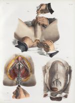 Planche 64 - Opérations de la lithotomie - Taille bilatérale - Traité complet de l'anatomie de l'hom [...]
