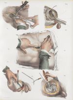 Planche 66 - Opérations de la lithotomie - Taille hypogastrique - Traité complet de l'anatomie de l' [...]