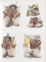 Planche 70 - Fistules vésico-vaginales - Traité complet de l'anatomie de l'homme, par les Drs Bourge [...]