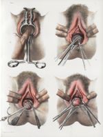 Planche 71 - Polypes du vagin et de l'utérus - Traité complet de l'anatomie de l'homme, par les Drs  [...]