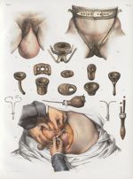 Planche 72 - Maladies de l'utérus - Traité complet de l'anatomie de l'homme, par les Drs Bourgery et [...]