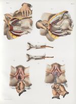 Planche 73 - Maladies de l'utérus - Traité complet de l'anatomie de l'homme, par les Drs Bourgery et [...]