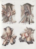 Planche 74 - Opérations sur l'utérus cancéreux - Traité complet de l'anatomie de l'homme, par les Dr [...]
