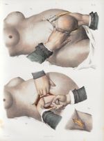 Planche 77 - Opération césarienne - Symphyséotomie - Traité complet de l'anatomie de l'homme, par le [...]