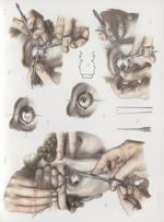 Planche B - Opérations du strabisme - Traité complet de l'anatomie de l'homme, par les Drs Bourgery  [...]
