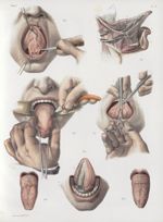 Planche F - Opération du bégaiement - Traité complet de l'anatomie de l'homme, par les Drs Bourgery  [...]