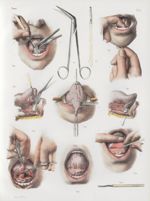 Planche G - Opération du bégaiement - Traité complet de l'anatomie de l'homme, par les Drs Bourgery  [...]