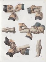 Planche H - Opérations sur le pied-bot - Traité complet de l'anatomie de l'homme, par les Drs Bourge [...]