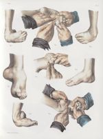 Planche I - Opérations sur le pied-bot - Traité complet de l'anatomie de l'homme, par les Drs Bourge [...]