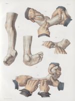 Planche J - Opérations sur le pied-bot - Traité complet de l'anatomie de l'homme, par les Drs Bourge [...]