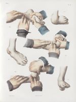 Planche K - Opérations sur le pied-bot - Traité complet de l'anatomie de l'homme, par les Drs Bourge [...]