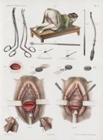 Planche V - Fistules urinaires chez la femme - Traité complet de l'anatomie de l'homme, par les Drs  [...]