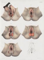 Planche VI - Restauration du périnée - Traité complet de l'anatomie de l'homme, par les Drs Bourgery [...]