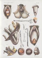 Planche XI - Amputation du col de l'utérus ; allongement hypertrophique ; prolapsus - Traité complet [...]