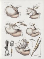 Planche XIII - Ovariotomie ; ligature anatomique - Traité complet de l'anatomie de l'homme, par les  [...]