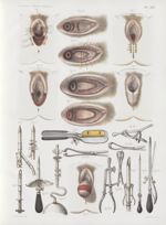 Planche XIV - Opération contre la cystocèle et la rectocèle vaginales ; le prolapsus de l'utérus et  [...]
