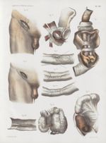 Planche XVI - Étranglements internes ; entérotomie ; suture intestinale - Traité complet de l'anatom [...]