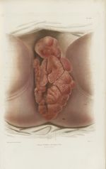 Planche CLIV. Végétations syphilitiques pendant la grossesse - Traité d'anatomie pathologique généra [...]