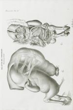 Malattie del peritoneo. Gravidanza peritoneale - Atlante generale della anatomia patologica del corp [...]