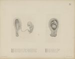 Fig. 6. - Uterus mit Fötus 3/5 Monates. Beginnende Placenta praevia. Fig. 7. - Uterus mit Fötus von  [...]