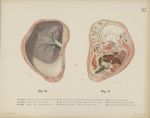Fig. 16. - Uterus ohne Kind. Beginnende Erweiterung des inneren Muttermundes. Fig. 17. - Uterus mit  [...]