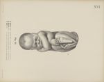 Fig. 23. - X. Monat (Ende). Dasselbe Kind in natürlicher Haltung von vorn betrachtet - Uterus und Ki [...]