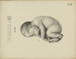 Fig. 24. -  X. Monat (Ende). Dasselbe Kind in natürlicher Haltung von der Seite - Uterus und Kind vo [...]