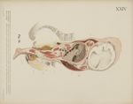Fig. 32. - Ende der Schwangerschaft. Mehrgebärende. Placenta praevia. Durchbohrung der Placenta bei  [...]