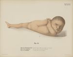 Fig. 34. - Ende der Schwangerschaft. Dasselbe Präparat: Kind von der linken Seite betrachtet - Uteru [...]