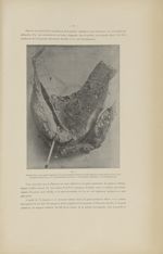 Fig. 5. Tranche droite, vue de gauche - Étude anatomique sur l'insertion vicieuse du placenta : coup [...]