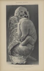 Coupe juxta médiane, verticale, antéro-postérieure - moitié gauche avec le segment du fœtus extrait  [...]