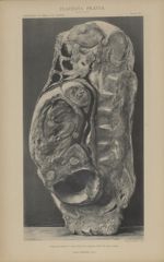 Coupe juxta médiane - moitie droite, fœtus en place - Étude anatomique sur l'insertion vicieuse du p [...]