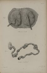 Pl. XX. - Placenta double / Fig. 2. - Cordon ombilical - Nouvelles démonstrations d'accouchemens