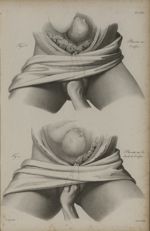Pl. LXXI. - Fig. 1. - Placenta sur l'orifice / Fig. 2. - Placenta sur les bords de l'orifice - Nouve [...]