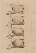 PL. XXV - histoire de la grossesse, vue de face. Fig. 1 - état naturel / Fig. 2 - 3 mois / Fig. 3 -  [...]