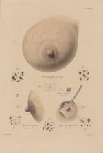 PL. LXXVIII. Fig. 1 - mamelle gonflée par le lait / Fig. 2 - papile d'une femme qui nourrit / Fig. 3 [...]