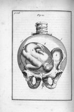Fig. 20. L'enfant [dans la matrice], dont la tête est collée contre l'os des îles gauche - Observati [...]