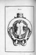 Fig. 19. L'enfant [dans la matrice], dont la tête est arrêtée contre les os pubis - Observations imp [...]