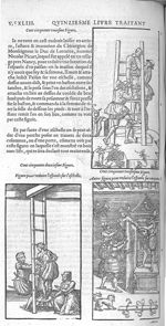 Fig. 151 à 153. Maniere de reduire l'espaule avec une eschelle - Les Oeuvres d’Ambroise Paré, consei [...]