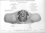 Planche 28. Coupe de tronçonnage trans-glottique. Segment inférieur - Atlas d'anatomie topographique [...]