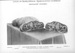 Planche 32. Coupe de tronçonnage trans-scapulo humérale. Photographie d'ensemble - Atlas d'anatomie  [...]