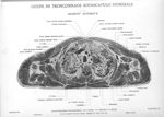 Planche 36. Coupe de tronçonnage sous-scapulo humérale. Segment supérieur - Atlas d'anatomie topogra [...]