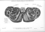 Planche 23. Coupe de tronçonnage sous-périnéale - Atlas d'anatomie topographique. Vol. 2 [fascicule  [...]