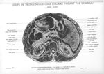 Coupe de tronçonnage chez l'homme passant par l'ombilic. Hors série - Atlas d'anatomie topographique [...]