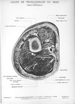 Planche 24. Coupe de tronçonnage du bras. Tiers supérieur - Atlas d'anatomie topographique. Vol. 3 [ [...]