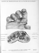 Planche 35. Coupe de tronçonnage de la paume de la main - Atlas d'anatomie topographique. Vol. 3 [fa [...]
